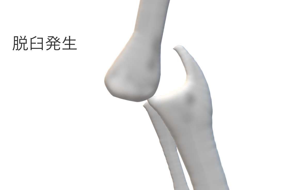 柔整理論 肘関節脱臼 柔整ブログ